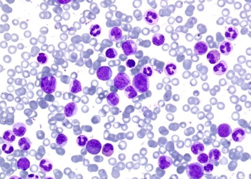 Leuçemia mielogjene kronike