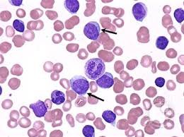 Leuçemia limfocitare kronike