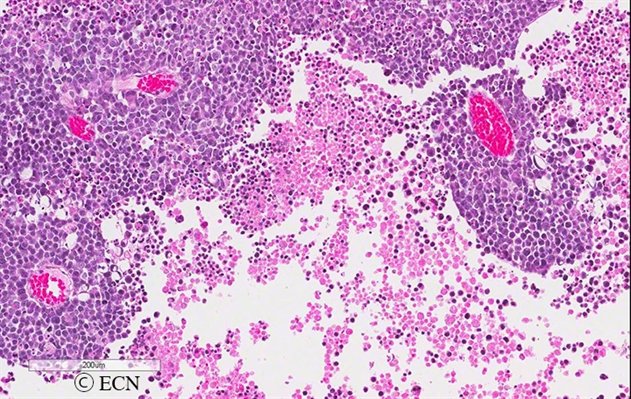 Retinoblastoma