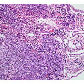 Tumori/kacionoma gastrointestinal