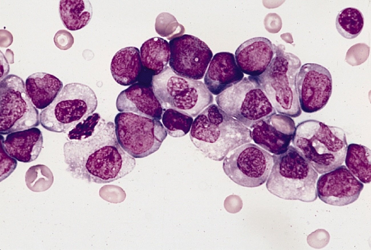 Leuçemia mielogjene akute